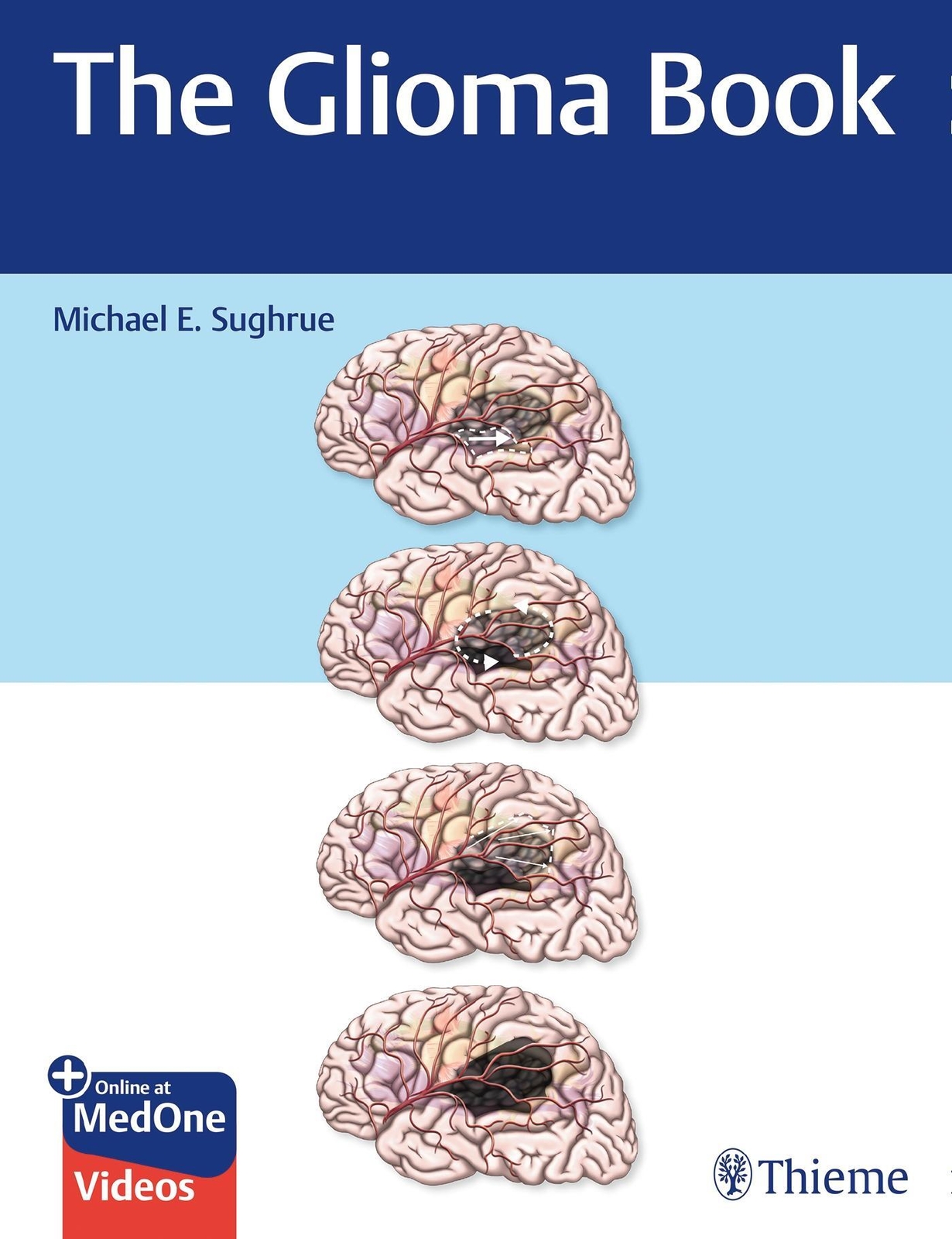 Thumbnail - The Glioma Book | Michael E. Sughrue | Englisch | Bundle | 1 Buch |
