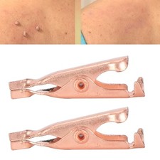 Small Skin Tag Remove Chip Pure Copper Tag Clips Body Wart Tag Extractor For FFG