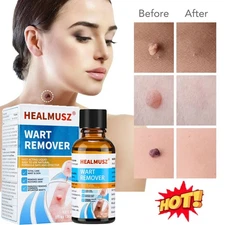 HEALMUSZ Wart Remover Liquid Plantar Wart Removers for Feet Body Fast Acting