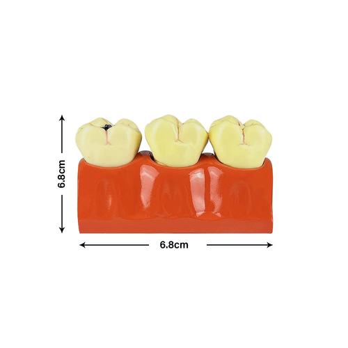 Dental 4 Times Caries Evolution Model Tooth Decay Comparsion Demonstration Model - 第 2/6 張圖片