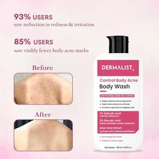 Dermalist AHA BHA Acne Body Wash Shower Gel Acne Control Unisex - 245 ml