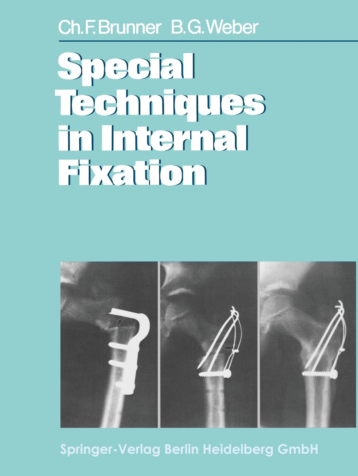 Thumbnail - Special Techniques In Internal Fixation C. F. Brunner (u. A.)