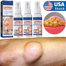 Lipomheilung Reduction Spray, Instant LumpFree Lipoma Removal Spray Hot US