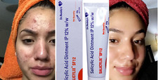Salicylic Acid 12 Ointment- 25g for Blemishes, Skin Redness Pack Of 1