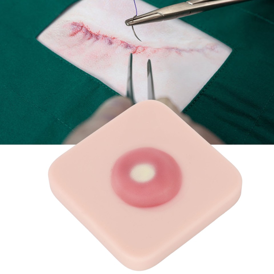 Abszess Inzision Drainage Pad Sebaceous Cyst Chirurgische Entfernung