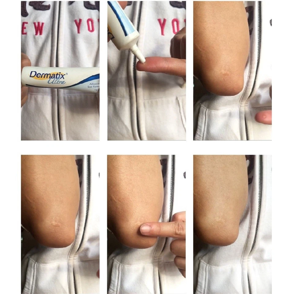 10x Scar Gel Dermatix Ultra 15g Advanced Formula Silicone Gel Treatment Exp 2027 - Image 4 of 4