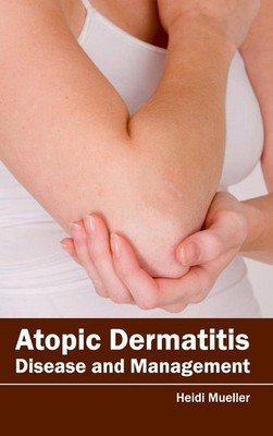 Atopic Dermatitis: Disease and Management [Hardcover]