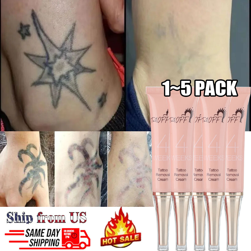 Share more than 68 ink eraser tattoo removal