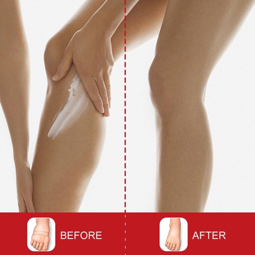 1pcs anti foot edema cream remove arm leg swelling pain relief ointment 20g2025 - Picture 11 of 13