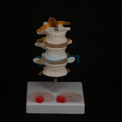 Human Three Lumbar Lesions Intervertebral Disc Skeleton Spine Medical Model #ea