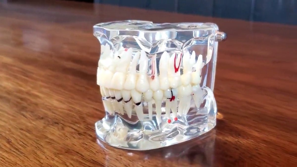 デモンストレーションモデル A1 Disease Teeth Model, Clear Dental Teeth Model, Vintage Medical