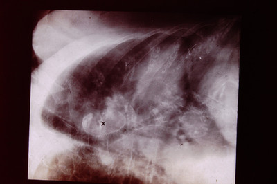 No Date Medical Slide X-Ray Mass Produced  Slide CD-K