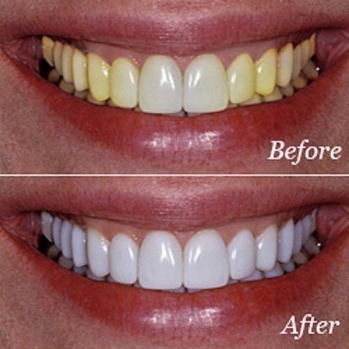 KIT SBIANCAMENTO DENTI 6x3cc SIRINGHE + 4 STAMPI DENTI + PENNA GEL + LUCE LASER - Foto 5 di 13