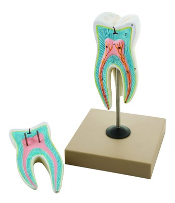 Labs Detailed Upper Triple Root Molar with Caries, Enlarged 15 Times, 2 Part ...