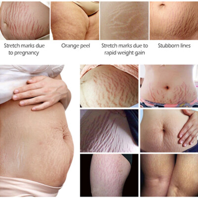 30ml Stretch Mark Cream For Pregnancy Stretch Mark Scar Cream