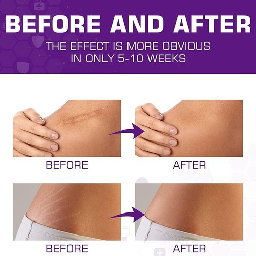 30ML Scar Gel Cream Stretch Marks Removal Cream Surgery Scar Skin Care - Picture 3 of 6