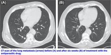 Old drug in new role: dramatic regression of refractory metastatic colon cancer