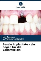 Basale Implantate - Ein Segen FüR Die Zahnmedizin Lizy Teena A