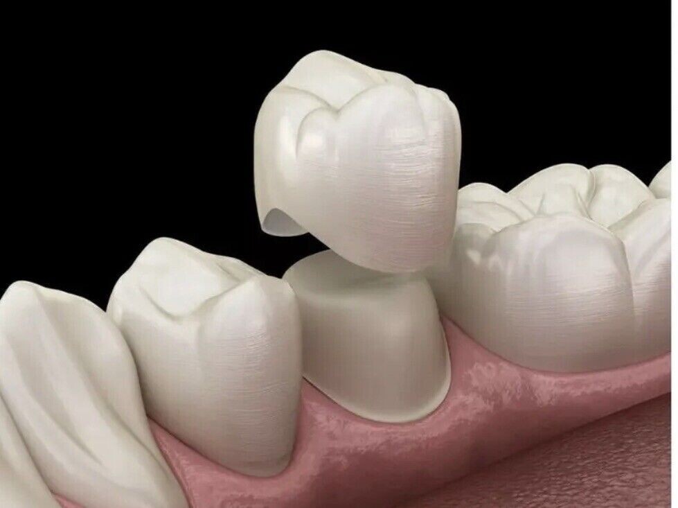 2x SPI Dental Cement Automix Self Adhesive For Crowns Bridges Implants Veneers eBay