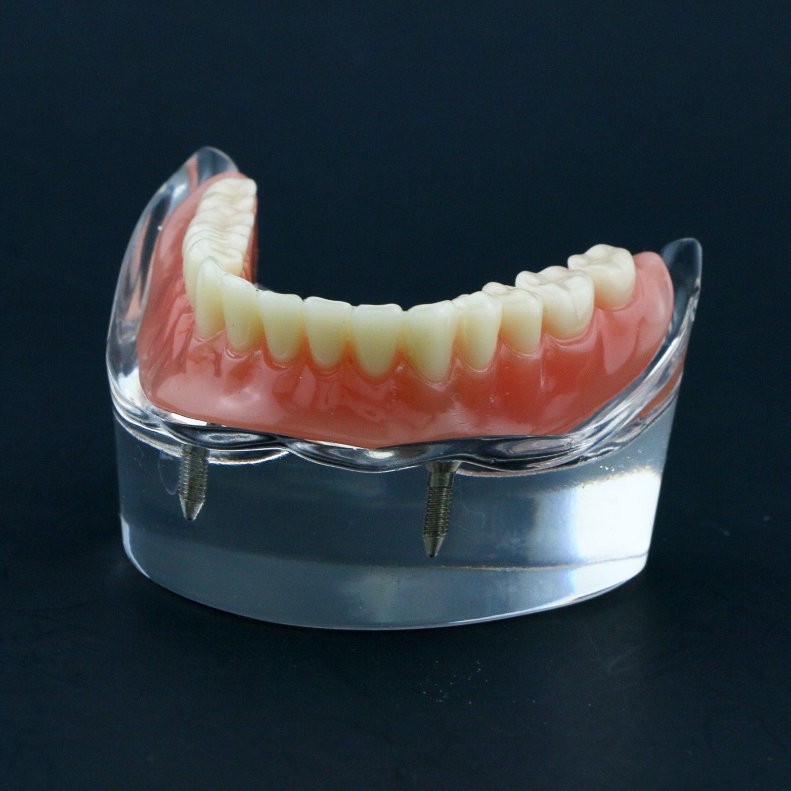 Dental Implant Teeth Model U/ L Demo Overdenture Restoration w/ 2 4