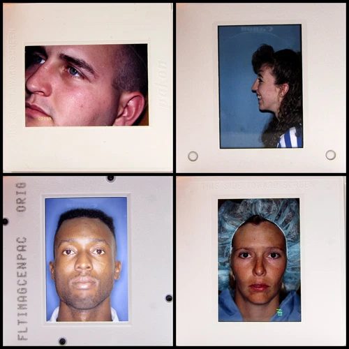 25 People Faces Slides - vintage 35mm Photo Slides lot - Medical Oddities