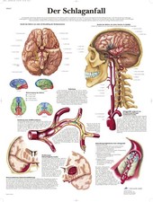 Lehrtafel 3B Scientific Schlaganfall Anatomie medizinisch 70x100 cm