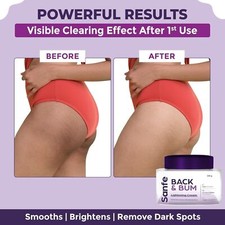 Sanfe Back  Bum Cream for Dark Spots and Body Acne  Glycolic Acid, Lactic 100g