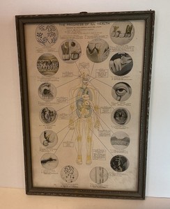 Antique Framed Human Diagram “The Progress Of Ill Health” By Rosenow, Billings