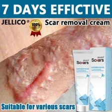 Scar Removal Cream Keloid & Stretch Mark Remover | Scar Treatment for Burns & Sc