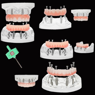 New Dental Implant Model All-on-4 All-on-6 Overdenture U/L Jaw 4/6 Screws Clear