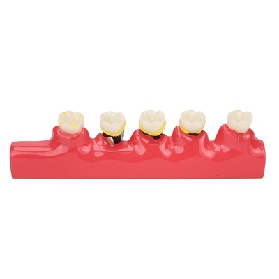Dental PerioBAKtal Disease Model Tooth Disease Study Teaching Model For Dent BAK