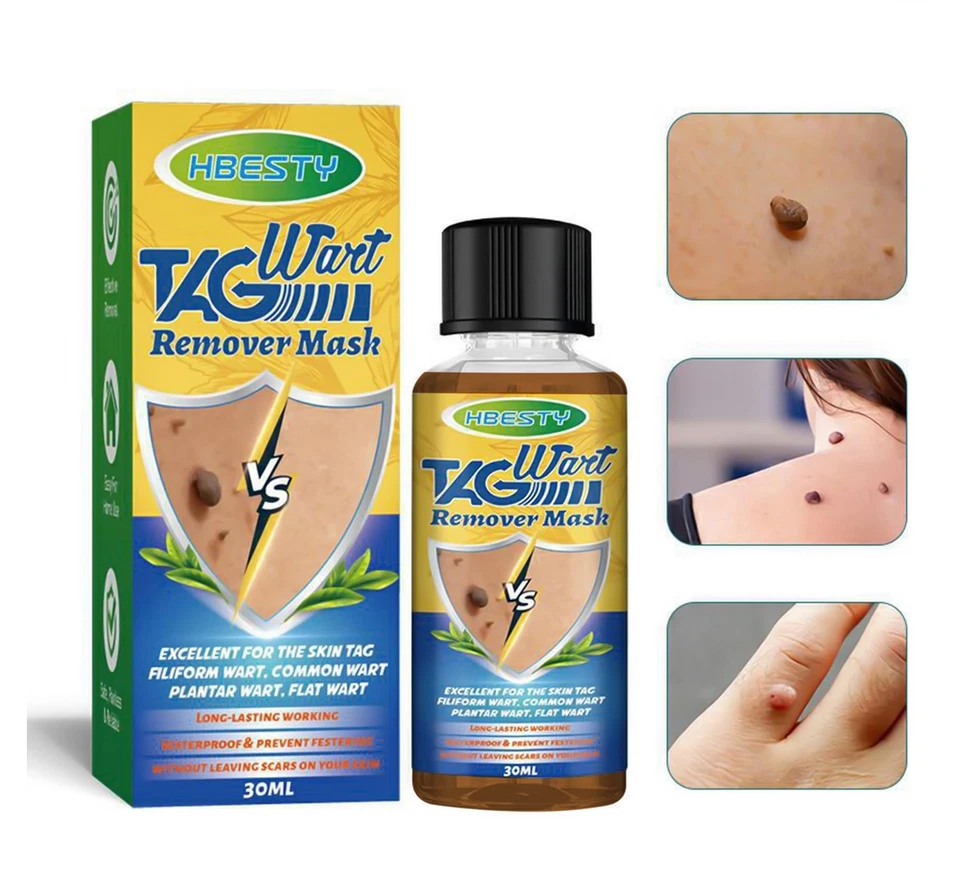 HBESTY 30ml Liquid Fast-Acting Wart, Skin-Tag Remover