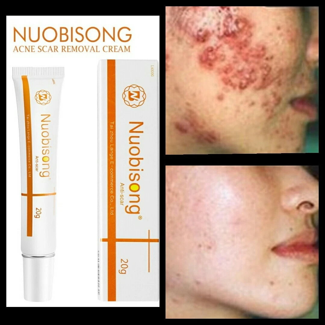 Best spot 2024 removal cream