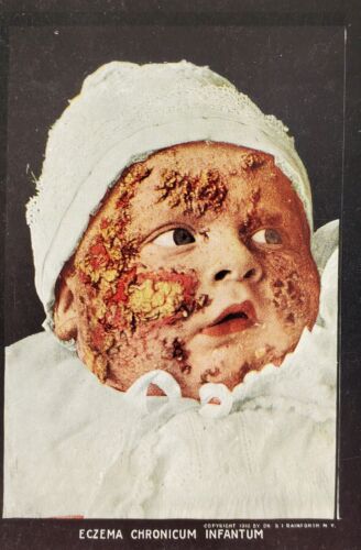 1910 MEDICAL SKIN DISEASE STEREOVIEW CARD ECZEMA CHRONICUM INFANTUM, RAINFORTH