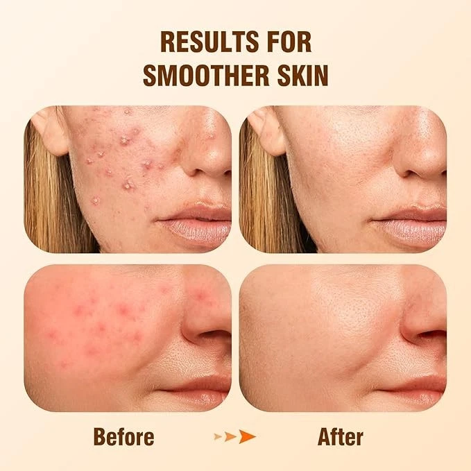 Biysber Salicylic Acid 2% Serum Moisturizes Skin Improves Acne 1.01 Fl Oz - Image 2 of 4