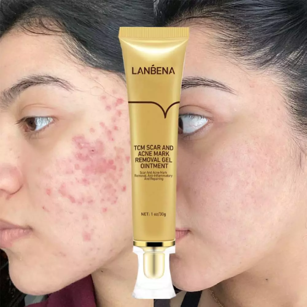 Best acne scar removal cream deals