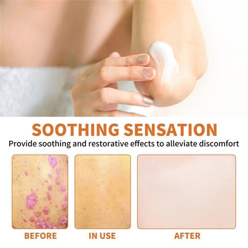 BeeVenom Psoriasis Treatment-Cream Dermatitis Eczema Mild Healing Antibacterial - Picture 8 of 14