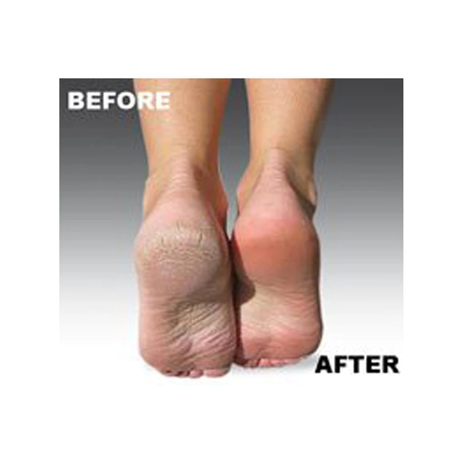 Paquete de 8 rodillos de recarga de pedicura gruesa Xtreme Comp. con removedor de callos Emjoi Foto 2 de 2