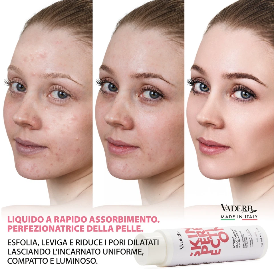 Lozione Brufoli Acne e Imperfezioni 150 ml Esfoliante Viso con Acido Salicilico - Immagine 4 di 4