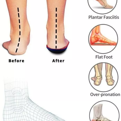 Orthotic Insoles For Arch Support Plantar Fasciitis Flat Feet Gel Heel Back Pain - Picture 4 of 11
