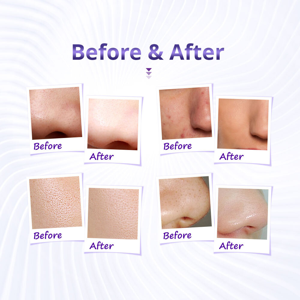 3 in1 Diamond Microdermabrasion Dermabrasion Facial Vacuum Spray Peel