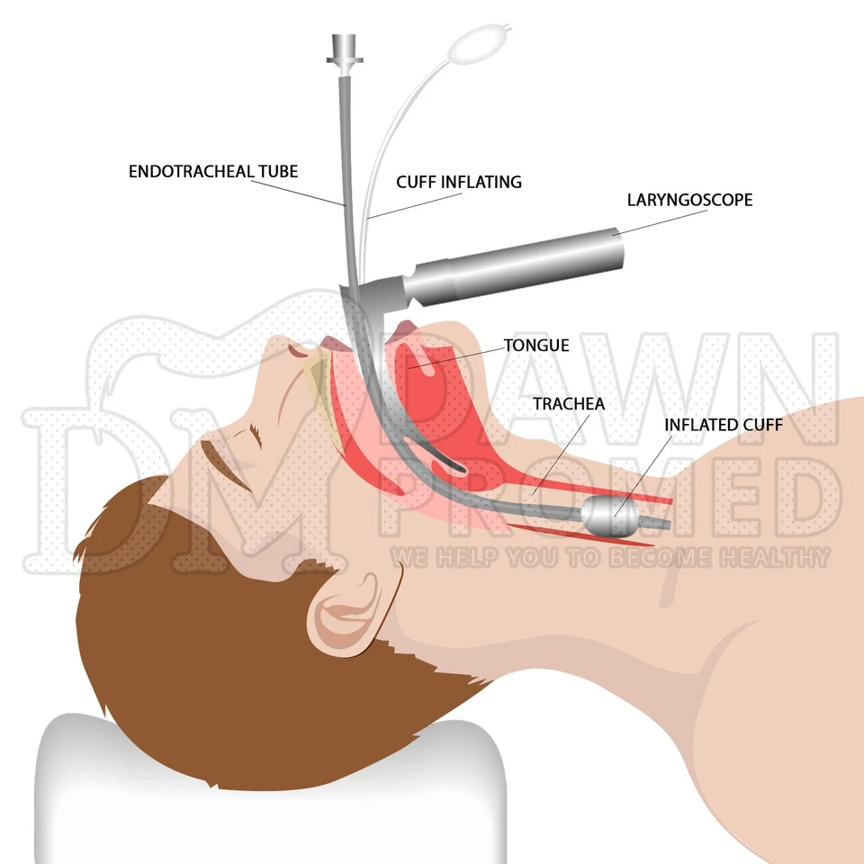 Kit de intubación de laringoscopio alemán 12 piezas hojas de fibra óptica Macintosh & Miller Foto 3 de 4