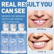 Tooth Repair Kit - Temporary Teeth Replacement Kit for Missing & Broken Teeth