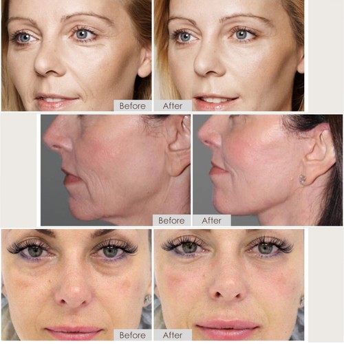 LEFAY Face Skin Tightening Machine RF-MAX-Plus Frequency Facial Device Massage - Picture 7 of 7