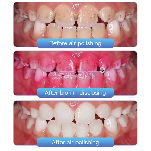 Pieza de mano de pulido dental de flujo de aire pulidor Jet 4Hole fit for Kavo - Picture 10 of 30