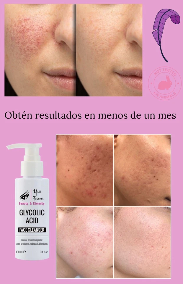 acne treatment, skin care, face cleanser, acne, jabón facial, tratamiento para c - Image 3 of 4
