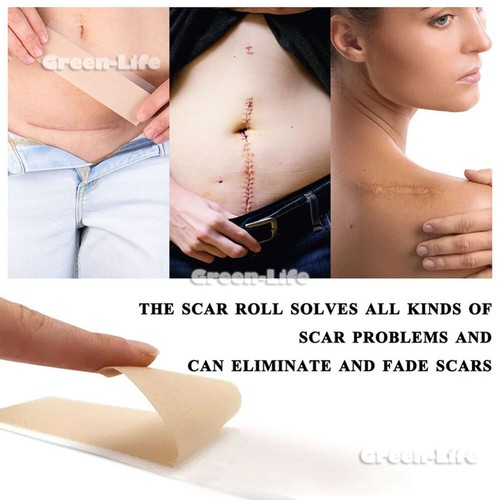 Silicone Scar Sheets & Tape Roll 1.5/3/5M | Scar Removal, Keloid, Acne, Marks - Picture 3 of 20