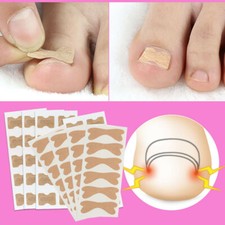 Self Adhesive Ingrown Toenail Corrector Toe Foot Nail Sticker Pedicure Tool⇖