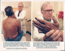 1994 Los Angeles County Usc Hansens Disease Center Patient 8X10 Vintage Photo