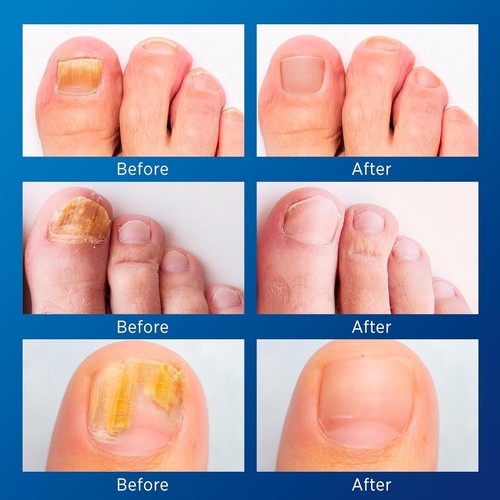 Toenail Fungus Treatment – 21 Hydrogel Patches for Overnight Nail Repair - Picture 7 of 9